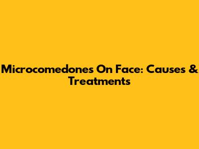 Microcomedones On Face: Causes & Treatments